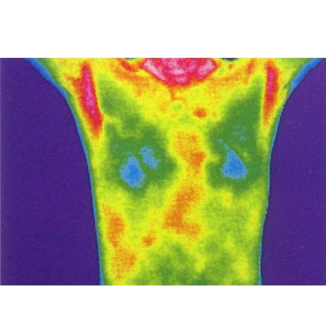   乳腺診斷

熱成像可以用來檢測(cè)乳房組織的溫度差異，由于腫瘤組織的新陳代謝通常高于正常組織，它們可能會(huì)在熱圖像上表現(xiàn)為熱斑。